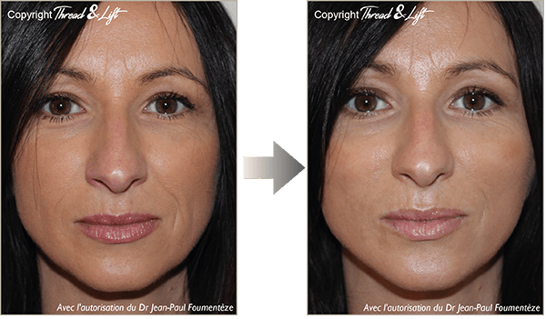 Thread & Lift - The 1st real facelift without surgery