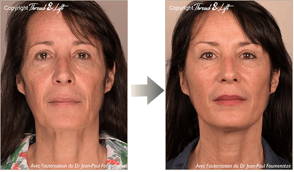 Thread & Lift - The 1st real facelift without surgery