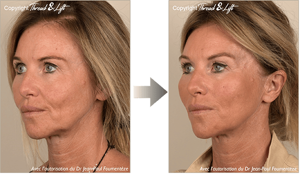 Thread & Lift - The 1st real facelift without surgery