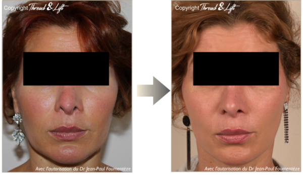 Thread-And-Lift-Results-1.3_44-transparent-logo-et-courtesy-1024x592