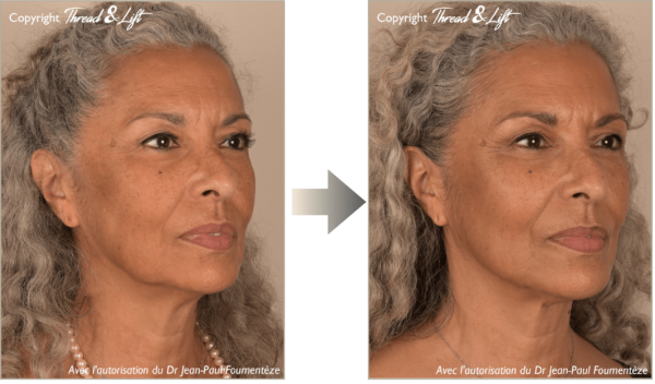 Thread-And-Lift-Results-1.5_2 (transparent, logo et courtesy)-min