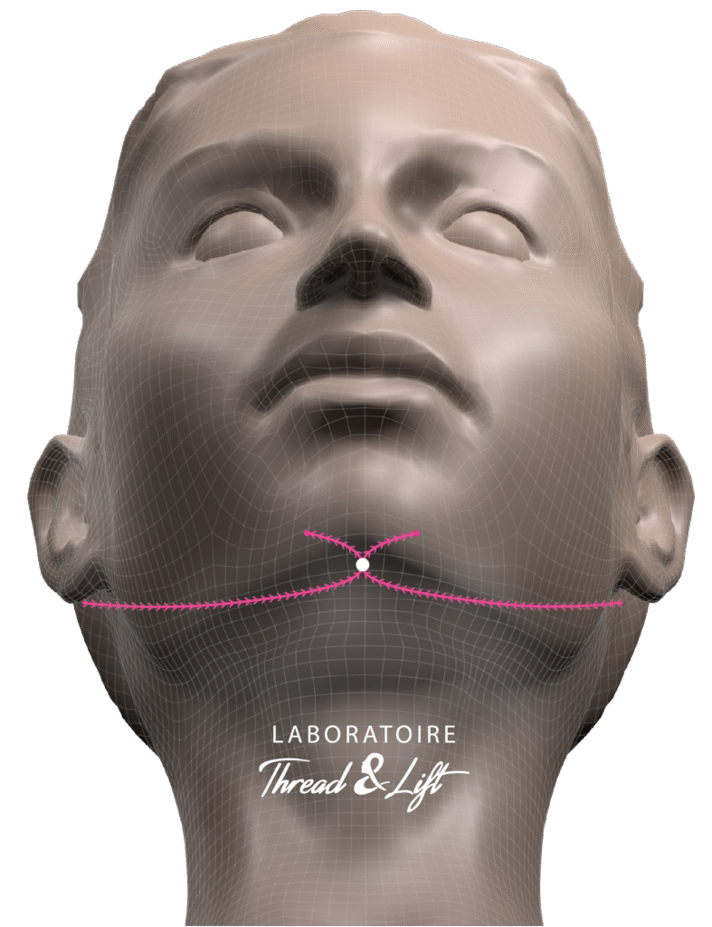 Below view - Neck - Single crossing